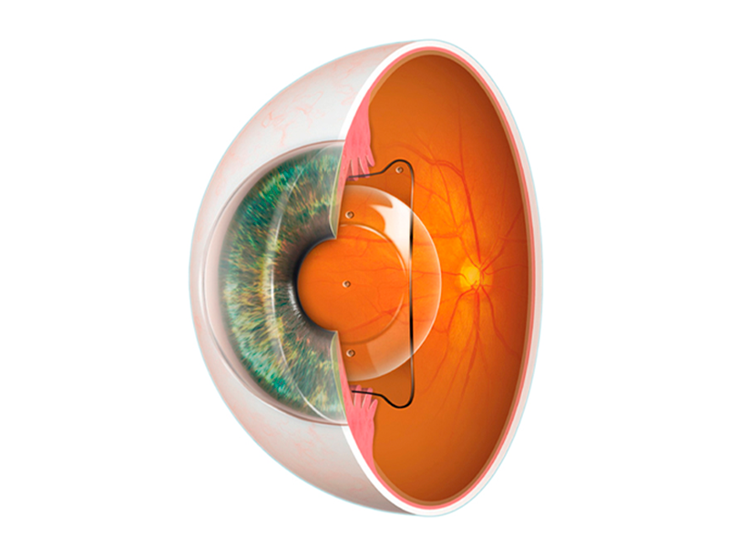 Lentes ICL