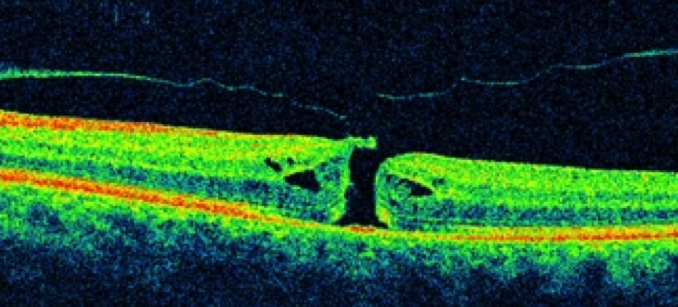 AGUJERO MACULAR