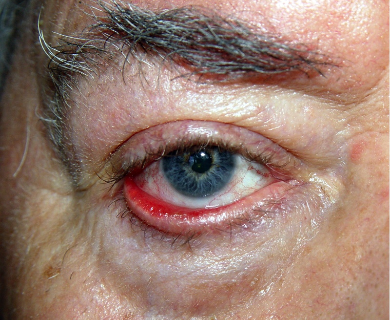 ECTROPION
