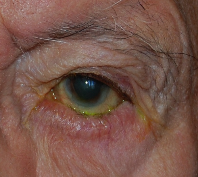 ENTROPION