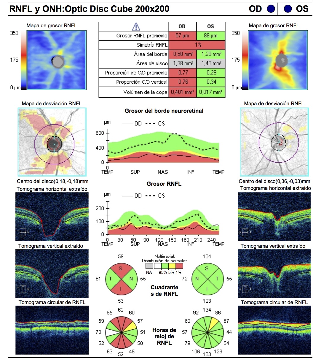 OCT GLAUCOMA TOLEDO