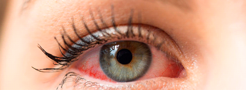 Ojo seco