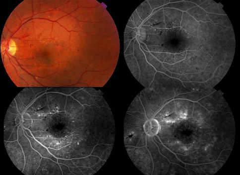 Degeneracion Macular