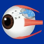 glaucoma