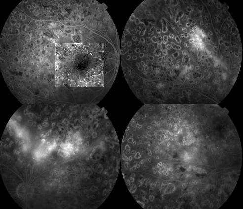 retinopatia diabetica