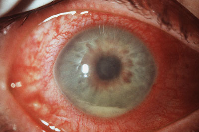 uveitis